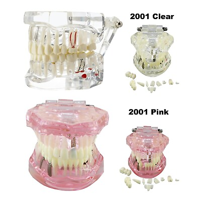 #ad Dental Implant Restoration Teeth Model Teach Demo M2001 Clear Pink Removable New $39.89